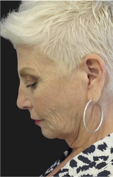 Neck Lift Before Photo by Munique Maia, MD; Tysons Corner, VA - Case 49392