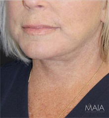 Neck Lift After Photo by Munique Maia, MD; Tysons Corner, VA - Case 49372