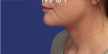 Neck Lift After Photo by Munique Maia, MD; Tysons Corner, VA - Case 49393