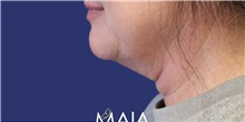 Neck Lift Before Photo by Munique Maia, MD; Tysons Corner, VA - Case 49393