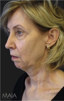 Neck Lift Before Photo by Munique Maia, MD; Tysons Corner, VA - Case 49367