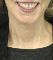 Neck Lift After Photo by Munique Maia, MD; Tysons Corner, VA - Case 49367