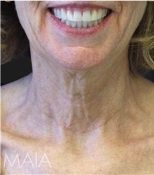 Neck Lift Before Photo by Munique Maia, MD; Tysons Corner, VA - Case 49367