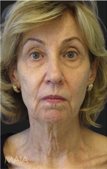 Neck Lift Before Photo by Munique Maia, MD; Tysons Corner, VA - Case 49367