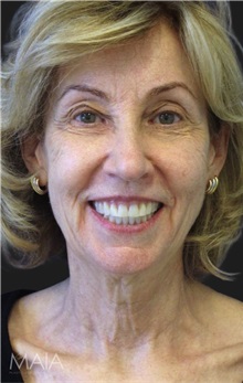 Neck Lift Before Photo by Munique Maia, MD; Tysons Corner, VA - Case 49367