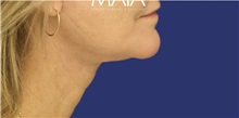 Neck Lift After Photo by Munique Maia, MD; Tysons Corner, VA - Case 49370