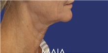 Neck Lift Before Photo by Munique Maia, MD; Tysons Corner, VA - Case 49370