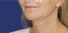 Neck Lift After Photo by Munique Maia, MD; Tysons Corner, VA - Case 49370