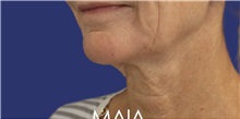 Neck Lift Before Photo by Munique Maia, MD; Tysons Corner, VA - Case 49370