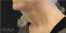 Neck Lift After Photo by Munique Maia, MD; Tysons Corner, VA - Case 49368