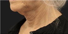 Neck Lift Before Photo by Munique Maia, MD; Tysons Corner, VA - Case 49368