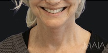 Neck Lift After Photo by Munique Maia, MD; Tysons Corner, VA - Case 49368