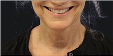 Neck Lift Before Photo by Munique Maia, MD; Tysons Corner, VA - Case 49368