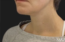 Neck Lift After Photo by Munique Maia, MD; Tysons Corner, VA - Case 49369