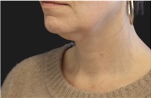 Neck Lift Before Photo by Munique Maia, MD; Tysons Corner, VA - Case 49369