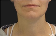 Neck Lift After Photo by Munique Maia, MD; Tysons Corner, VA - Case 49369