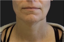 Neck Lift Before Photo by Munique Maia, MD; Tysons Corner, VA - Case 49369