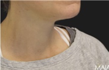 Neck Lift After Photo by Munique Maia, MD; Tysons Corner, VA - Case 49369