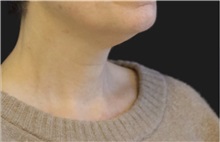 Neck Lift Before Photo by Munique Maia, MD; Tysons Corner, VA - Case 49369