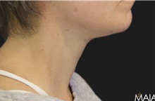 Neck Lift After Photo by Munique Maia, MD; Tysons Corner, VA - Case 49369