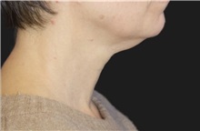 Neck Lift Before Photo by Munique Maia, MD; Tysons Corner, VA - Case 49369