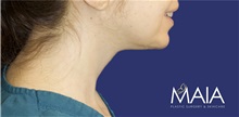 Neck Lift After Photo by Munique Maia, MD; Tysons Corner, VA - Case 49376