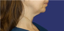 Neck Lift Before Photo by Munique Maia, MD; Tysons Corner, VA - Case 49376