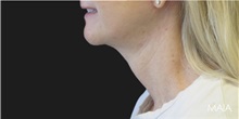 Neck Lift After Photo by Munique Maia, MD; Tysons Corner, VA - Case 49374