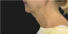 Neck Lift Before Photo by Munique Maia, MD; Tysons Corner, VA - Case 49374