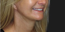 Neck Lift After Photo by Munique Maia, MD; Tysons Corner, VA - Case 49374