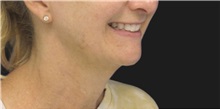 Neck Lift Before Photo by Munique Maia, MD; Tysons Corner, VA - Case 49374