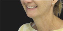 Neck Lift Before Photo by Munique Maia, MD; Tysons Corner, VA - Case 49374