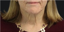 Neck Lift Before Photo by Munique Maia, MD; Tysons Corner, VA - Case 49375