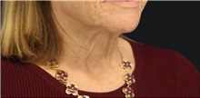 Neck Lift Before Photo by Munique Maia, MD; Tysons Corner, VA - Case 49375