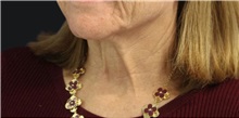 Neck Lift Before Photo by Munique Maia, MD; Tysons Corner, VA - Case 49375