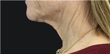 Neck Lift Before Photo by Munique Maia, MD; Tysons Corner, VA - Case 49375