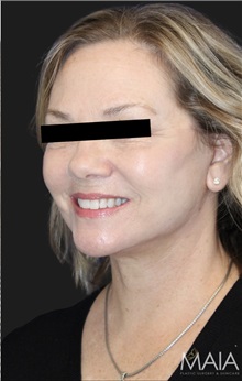 Neck Lift After Photo by Munique Maia, MD; Tysons Corner, VA - Case 49377