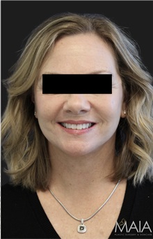 Neck Lift After Photo by Munique Maia, MD; Tysons Corner, VA - Case 49377