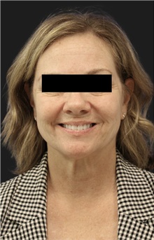 Neck Lift Before Photo by Munique Maia, MD; Tysons Corner, VA - Case 49377