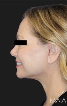 Neck Lift After Photo by Munique Maia, MD; Tysons Corner, VA - Case 49377