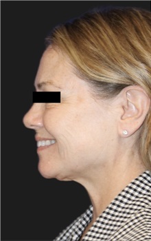 Neck Lift Before Photo by Munique Maia, MD; Tysons Corner, VA - Case 49377