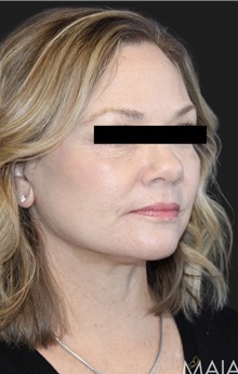 Neck Lift After Photo by Munique Maia, MD; Tysons Corner, VA - Case 49377