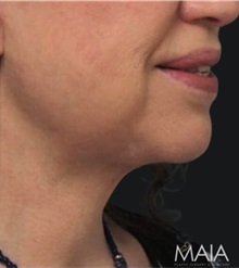 Neck Lift After Photo by Munique Maia, MD; Tysons Corner, VA - Case 49378