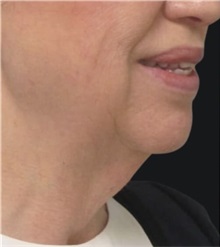 Neck Lift Before Photo by Munique Maia, MD; Tysons Corner, VA - Case 49378