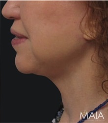 Neck Lift After Photo by Munique Maia, MD; Tysons Corner, VA - Case 49378