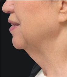 Neck Lift Before Photo by Munique Maia, MD; Tysons Corner, VA - Case 49378