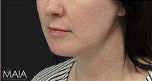 Neck Lift After Photo by Munique Maia, MD; Tysons Corner, VA - Case 49359