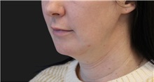 Neck Lift Before Photo by Munique Maia, MD; Tysons Corner, VA - Case 49359