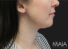 Neck Lift After Photo by Munique Maia, MD; Tysons Corner, VA - Case 49359