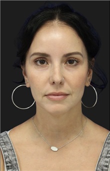 Neck Lift Before Photo by Munique Maia, MD; Tysons Corner, VA - Case 49360